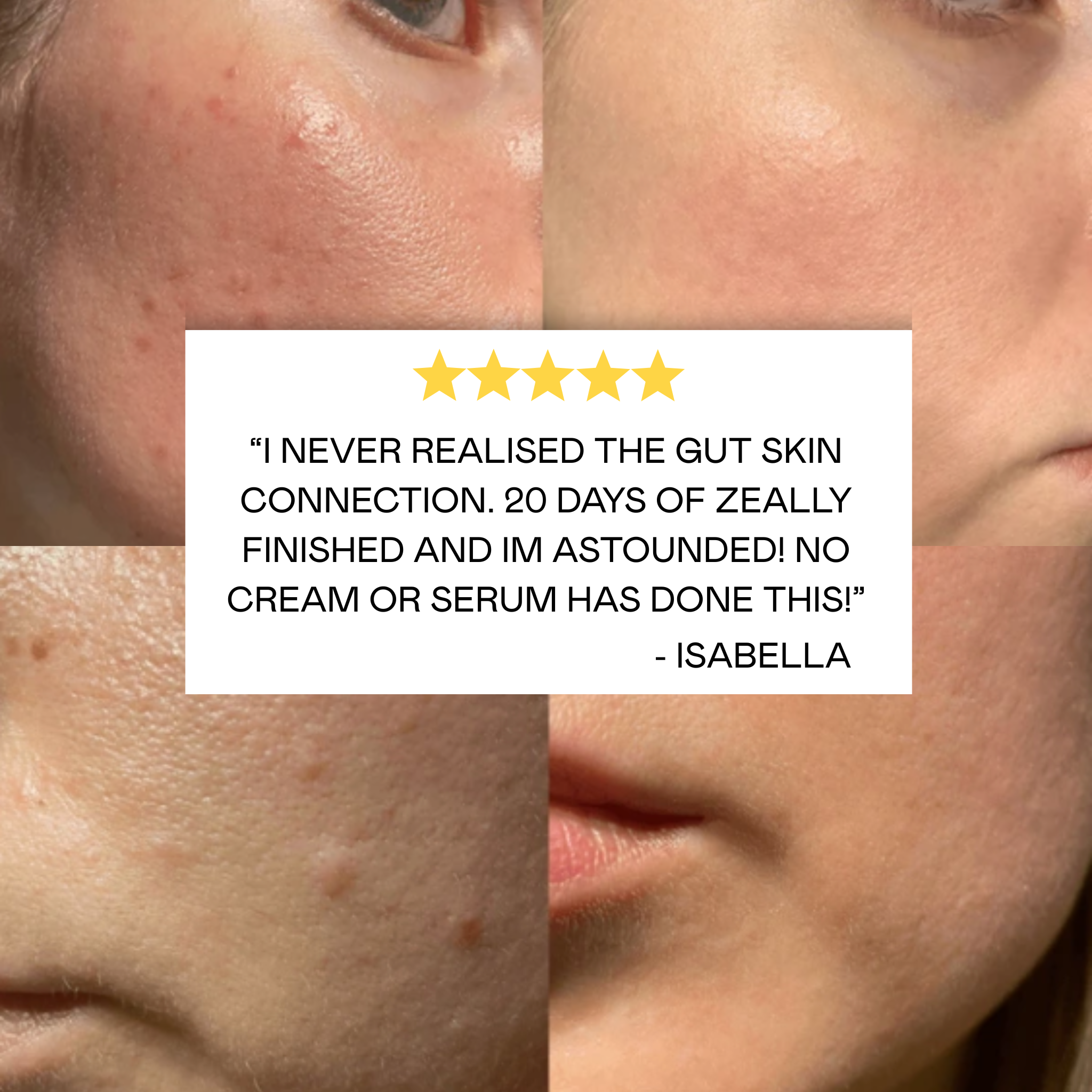 10 Day Parasite & Heavy Metal Cleanse results for Skin and Acne